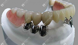 假牙制作方法视频,从视频学习精湛工艺